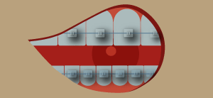 dibujo-brackets-esteticos