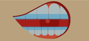 dibujo ortodoncia invisible vs brackets esteticos