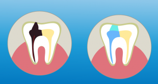 endodoncia precios burgos