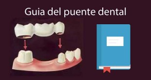 puente dental precio guia