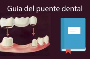 puente dental precio guia