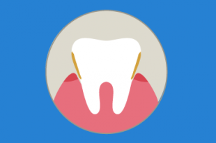 sarro en los dientes