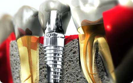 implantes dentales en burgos osteointegrados