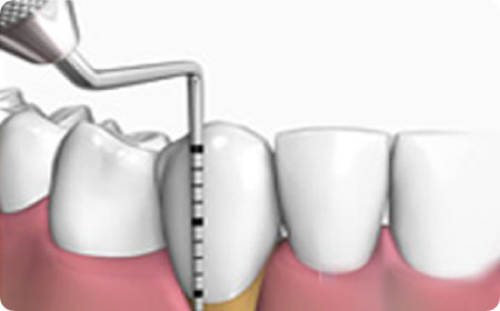 periodoncia en burgos tratamiento encías